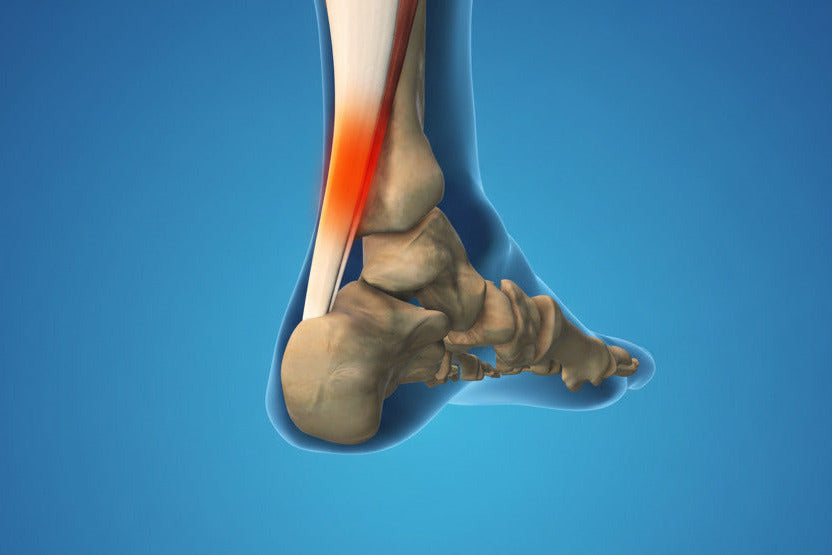 Achilles Tendonitis
