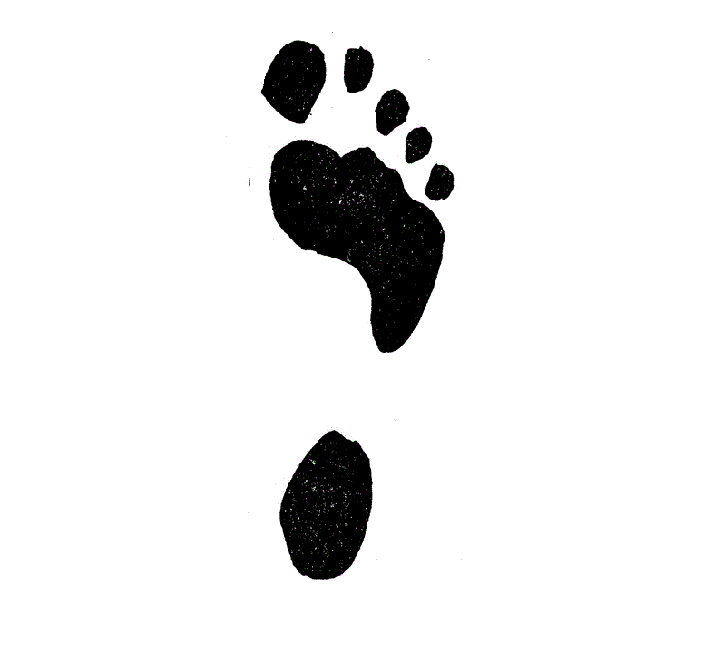 Pes cavus2.gif